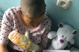 Bela Ibunya, Anak Gadis ini Disiram Bensin oleh Ayahnya Lalu Dibakar