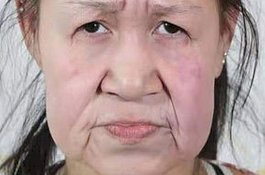 Mukanya Kelihatan Tua, Gadis Ini Operasi 7 Jam, dan Hasilnya Mencengangkan