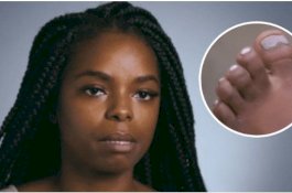 Jempol Kaki Gadis Ini Ada Dua dan Berhimpitan