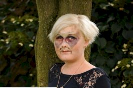 Wanita yang Menulis 'F**k Kanker' di Wajahnya Meninggal pada Usia 28