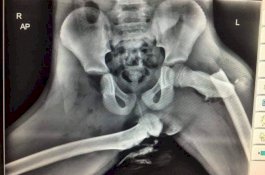 Wanita ini Suka Naikkan Kakinya di Dashboard Mobil, Begitu Kecelakaan Pinggulnya Patah