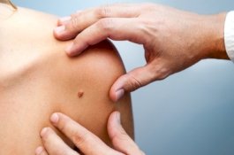 Keasyikan Main TikTok, Pria Ini Kaget saat Tahu Tahi Lalatnya Tanda Kanker Kulit