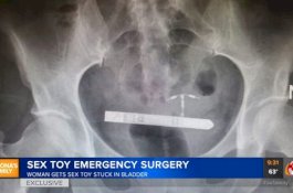 Mainan Seks yang Masih Bergetar Terjebak dalam Kelamin Wanita Ini