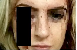 Wanita Cantik Buta Setelah Tengkorak Kepalanya Dihantam Palu