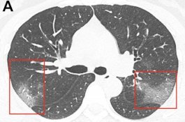 Foto X-Ray Menunjukkan Efek Mengerikan Coronavirus pada Paru-paru Pasien