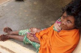 Dijuluki Penyihir, Perempuan di India Punya 31 Jari Masuk Guinness World Records
