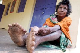 Lahir dengan 31 Jari, Wanita Ini Tak Dapat Bantuan karena Dikira Penyihir