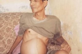 Perut Pria di Takalar Membesar seperti Orang Hamil, Dinkes Bilang Kasus Langka