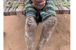 Kulit Gadis 7 Tahun Ini Mengeras, Tubuhnya Nyaris Menjadi 'Batu'