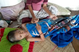 Anak 10 Tahun Kena Hidrosefalus, Ini Imbauan KPAI ke Pemkab Takalar