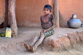 Derita Kondisi Kulit Langka, Gadis Ini Berubah Menjadi 'Batu'