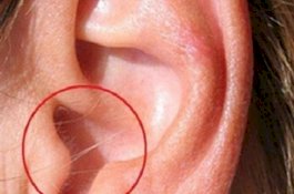 Punya Rambut di Telinga, Bisa Jadi Tanda Penyakit Mematikan