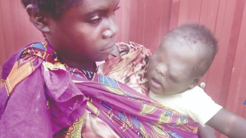 Lahir dengan Kondisi Langka, Dua Mata Bayi Ini Tertutup Kulit