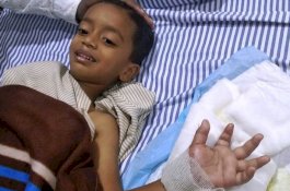 Tangan Balita Terputus Akibat Mesin Pemotong Rumput, Berhasil Disambung Ulang