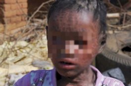 Kulit Bocah Ini Retak, Kering dan Bersisik, Teman-temannya Takut