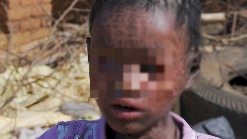 Babita, 7, menderita kondisi kulit yang melemahkan yang tidak mampu diobati orang tuanya (Gambar: Newslions / Jam Press)