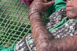 Derita Kelainan Kulit, Gadis Ini Kesulitan Bergerak dan Duduk