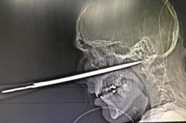 Pria Nyaris Tewas Usai Pisau Tertancap di Wajahnya, Kurang 1mm dari Kematian