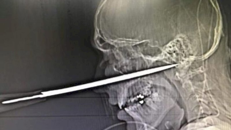 Pria Nyaris Tewas Usai Pisau Tertancap di Wajahnya, Kurang 1mm dari Kematian