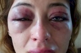 Tunjukkan Memar di Wajah, Model ini Mengaku Dipukuli Pacar saat Sedang Tidur