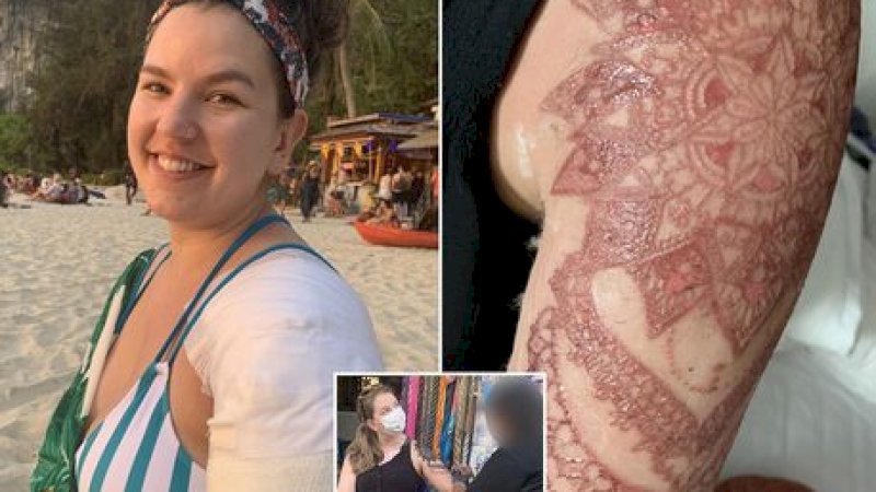 Pakai Tato Henna, Kulit Wanita Ini Melepuh Parah