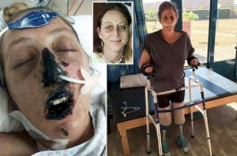 Digigit Luwak, Wanita Ini Harus Jalani 66 Operasi dan 4 Amputasi