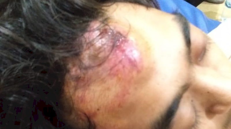 Salah satu luka yang dialami Abu Bakar.