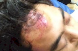 Kondisi Terkini ARB, Pelajar yang Ditarik Preman dari Kelas Hingga Benjol di Kepala