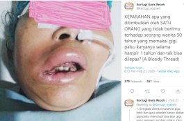 Gegara Tukang Gigi Abal-abal, Mulut Wanita Ini Bengkak Nyaris Tak Berbentuk