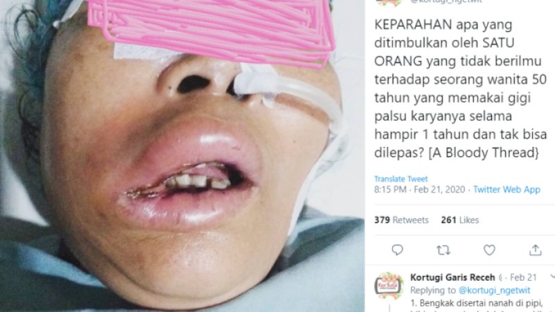 Gegara Tukang Gigi Abal-abal, Mulut Wanita Ini Bengkak Nyaris Tak Berbentuk