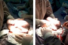 Hanya Terjadi pada 1 dari 80.000 Kelahiran, Bayi ini Lahir Dalam Kantung Ketuban