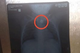 Bocah Telan Kelereng Langsung Dilarikan ke RS, Dokter: Tunggu BAB