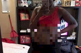 Terkena Tembakan, Sudah 3 Tahun Usus Wanita Ini Menggantung Keluar di Perutnya