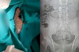 Perawat Muntah-muntah saat Mengeluarkan Ikan Nila di Perut Pria Ini