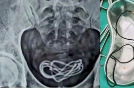 Ingin Puaskan Hasrat, Pria Ini Masukkan Kabel Charger 60 Cm ke Organ Intim