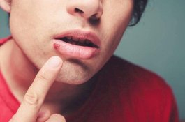 Pria Ini Gugat Teman Kencannya Rp2,4 Miliar karena Divonis Kena Herpes Usai Ciuman