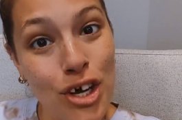 Gara-gara Makan Kue Beku, Gigi Model Cantik Ini Patah