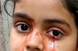Aneh, Bocah 11 Tahun di India Mengeluarkan Air Mata Darah