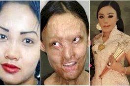 Si Cantik Lisa Korban Penyiraman Air Keras yang Kini jadi Pengusaha Perhiasan