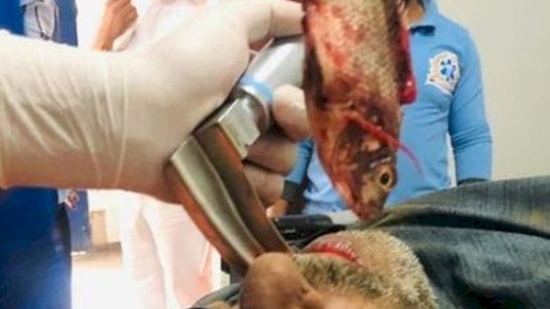 Lewat Gastroskopi, Ikan yang Dikeluarkan dari Tenggorokan Nelayan Ini Masih Hidup