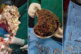 Wanita di India Mengeluh Sakit Perut, saat Dibedah Ditemukan 69 Kalung, 80 Anting dan 90 Koin