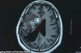 Otak Pria Ini Digerogoti Cacing Pita 12 Cm, Awalnya Dikira Tumor Ganas