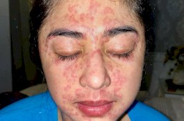 Kena Covid-19 Wajah Dewi Persik Alami Ruam Merah, Begini Penjelasan Medis