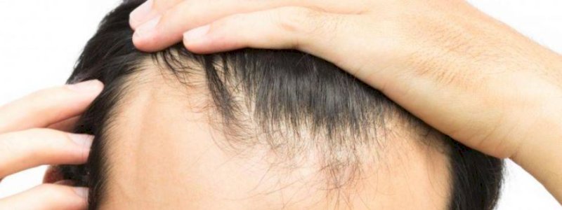 Rambut Rontok Jadi Salah Satu Dampak Covid-19