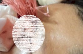 Sudah 4 Hari di RSWS, Panah yang Tertancap di Mata Pemuda Yatim Ini Belum Diangkat