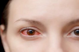 Gatal dan Sakit Mata Jadi Gejala dari Varian Baru Covid-19