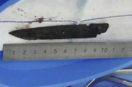 Selama 26 Tahun Pisau Berkarat 10 Sentimeter Bersarang di Kepala Pria Ini