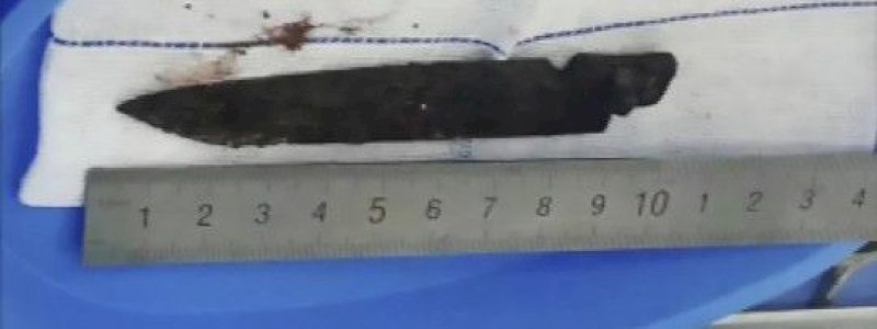 Selama 26 Tahun Pisau Berkarat 10 Sentimeter Bersarang di Kepala Pria Ini