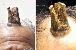 Tumbuh Tanduk di Kepala Pria Ini Setelah Terbentur Keras 5 Tahun Lalu