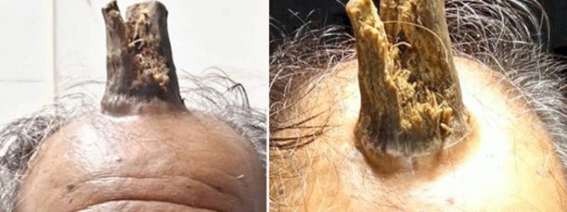 Tumbuh Tanduk di Kepala Pria Ini Setelah Terbentur Keras 5 Tahun Lalu